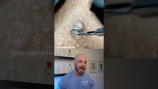 Gnarly ingrown hair removal dermreacts doctorreacts ingrownhair [upl. by Ryley]