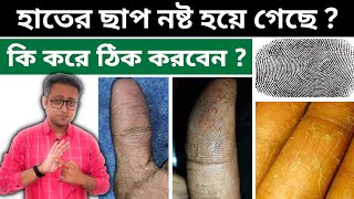 Fingerprint আসছে না  হাতের ছাল উঠছে  কি করবেন  Bengali  Dr Supratim Saha [upl. by Dickens]