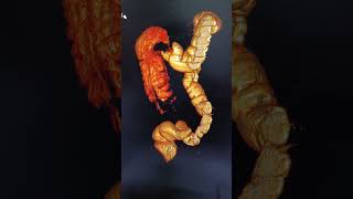 CT colonography 3D RECONSTRUCTION IMAGE paramedical [upl. by Adekahs]