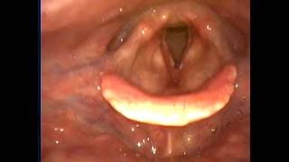 最常見的流鼻血位置  鼻前庭 Littles Area 與聲帶白斑 Vocal Leukoplakia amp Nasal Bleeder at Littles Area [upl. by Okimat575]