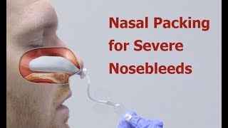 Nasal Packing for Severe Nosebleeds [upl. by Neirb]