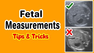 Fetal Measurements Tips and Tricks [upl. by Llehcam55]