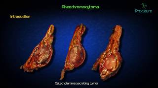 Pheochromocytoma usmle step 1  Etiology  Pathogenesis  clinical features  treatment [upl. by Dnallor]