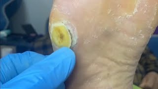 Pedicure video21，vertical plantaris，plantar wart [upl. by Oknuj]