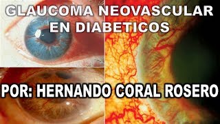 GLAUCOMA NEOVASCULAR EN DIABETICOS [upl. by Ferd]