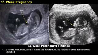 Obstetric Ultrasound Reporting  How To Write USG Reports  Pregnancy Sonography  TIFFA Scan [upl. by Pacheco]