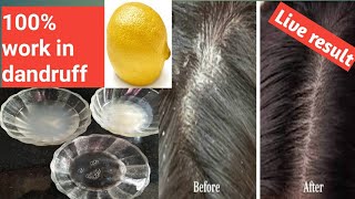 how to remove dandruff in one wash how to get rid of dandruff in one washscalp dandruff removal [upl. by Hey]