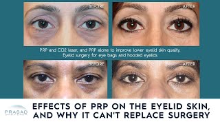 PRP is Effective for Eyelid Skin Rejuvenation but it Cant Replace Surgery or Fillers [upl. by Jovita]