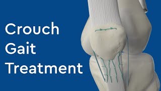 What is Crouch Gait Treatment [upl. by Lebezej]