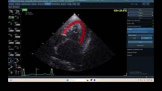 IQ 306 AFI LV ECHOPAC ANALYSIS HEPATOMA PTE ECHOCARDIOGRAPHY [upl. by Annalla446]