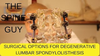 Surgical Options for Degenerative Lumbar Spondylolisthesis  Part 3 [upl. by Etterb32]