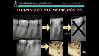 Diagnóstico e Tratamento do Insucesso em Endodontia [upl. by Iridissa177]