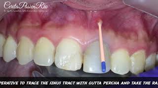 Tracing Sinus Tract With Gutta Percha Point TAKEN WITH XRAY IMAGE [upl. by Eibocaj]