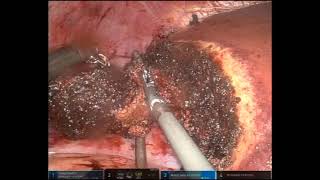 Simultaneous Robotic Right Colectomy with Intracorporeal Anastomosis and Partial Hepatectomy [upl. by Keele]