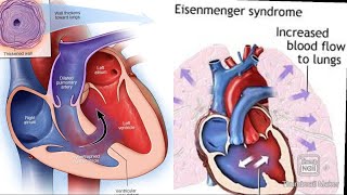 Eisenmenger syndrome fmge next neetpg [upl. by Vada504]