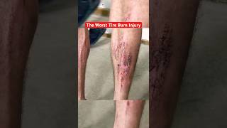 Creating the Worst Tire Burn Injury for Science funny comedy science [upl. by Analad]