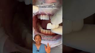 Replacing missing teeth with dental bridge dentalbridge missingteeth toothreplacement teethbits [upl. by Maclay238]