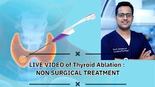 Live Video of Thyroid Ablation  Non Surgical treatment [upl. by Bart]