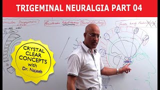 Trigeminal Neuralgia  Causes and Treatment  Part 4 [upl. by Alludba]