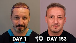 Day 7 after FUEDHI Hair Transplant Scab Removal  Wearing a Hat [upl. by Teahan]