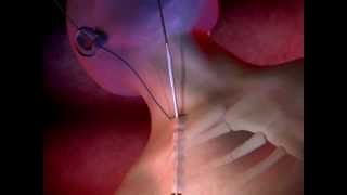 ProGuide™ Chronic Dialysis Catheters Animation [upl. by Harve860]