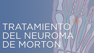 Tratamiento del Neuroma de Morton  Dolor en la planta del pie al caminar [upl. by Enelegna114]