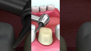 Révélation Dentaire  Le Processus de la Couronne Dévoilé [upl. by Oman]