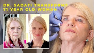 Dr Sadati Transforms 71 year old Woman with Lower Face and Neck Lift and Restylane Lyft Filler [upl. by Euhc458]