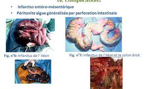 Lischémie intestinale aiguë [upl. by Shirlie]