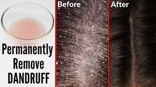 How to cure dandruff permanently naturally at home [upl. by Bonny487]