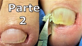 como sacar uña encarnada  como obter uma unha encravada  Impacted or Ingrown Toenail Pedicure [upl. by Ellehcar783]