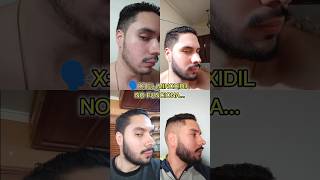 Seguimos con el minoxidil 🗿🧔🏻 minoxidil membersmark barba beard constancia sigma discipline [upl. by Dwinnell]