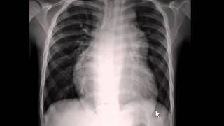 Chest xray  pulmonary arterial hypertension [upl. by Tabbitha22]