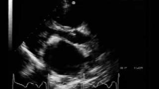 MS different aspectscalcified mitral stenosis [upl. by Nidnal]