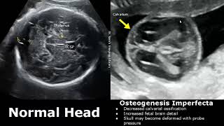 Fetal Musculoskeletal Ultrasound Normal Vs Abnormal Image Appearances  Skeletal Dysplasias MSK USG [upl. by Lauer]