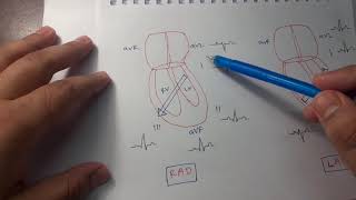 Clinical ECG Interpretation in Bangla Part 1 Heart rate Axis Hypertrophies [upl. by Estes357]