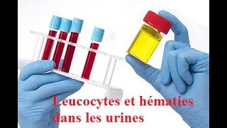 Leucocytes et hématies dans les urines [upl. by Josi]