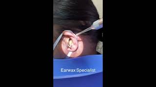 Removing Massive Earwax From Womans Ear [upl. by Naivat]