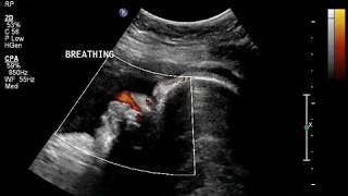 fetal breathing ultrasound doppler [upl. by Warram94]