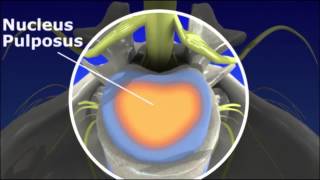 Herniated Disc  Pain Management [upl. by Collins3]