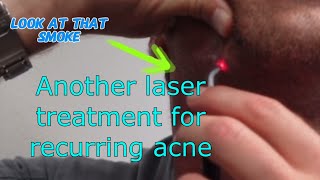 Laser treatment for acne A follow up [upl. by Martica420]