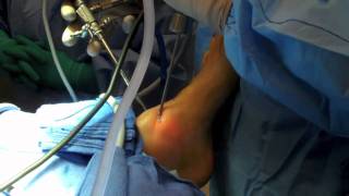 Ankle Arthroscopy [upl. by Comstock94]