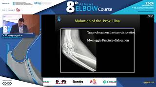 Malunion and nonunion of proximal ulnar fractures V Kontogeorgakos [upl. by Nnaaihtnyc]