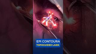 EPI Contoura Topoguided Lasik Surgery [upl. by Toile]