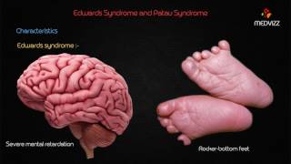 Edwards Syndrome and patau syndrome [upl. by Assenyl888]