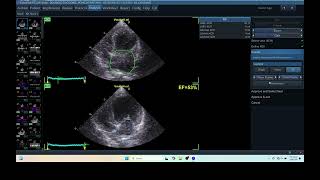 IQ 279 AFI LA HEPATOMA ECHOPAC ANALYSIS ECHOCARDIOGRAPHY [upl. by Aneled130]