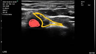 supraclavicular brachial plexus scanning by sonostar WiFi ultrasound [upl. by Anij580]