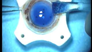 DALK with big bubble technique in keratoconus [upl. by Dearr]