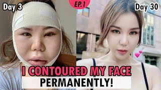 SUB Zygoma amp Jawline Reduction in Korea  vline facial bone surgery vlog review  Recovery Results [upl. by Suolekcin943]