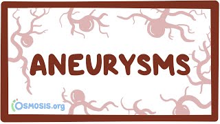 Aneurysms  causes symptoms diagnosis treatment pathology [upl. by Panchito150]